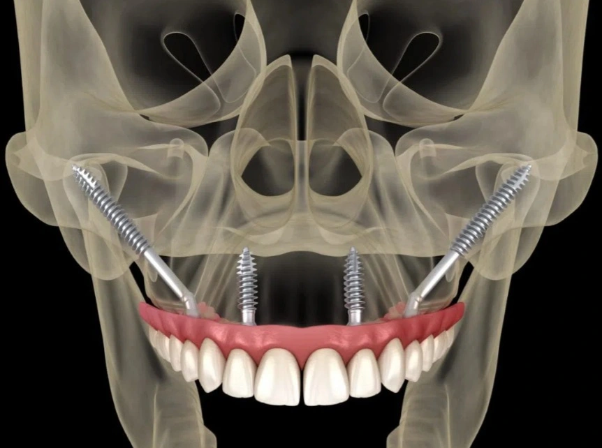 Best dental implants treatment in Kolkata. Painless process.